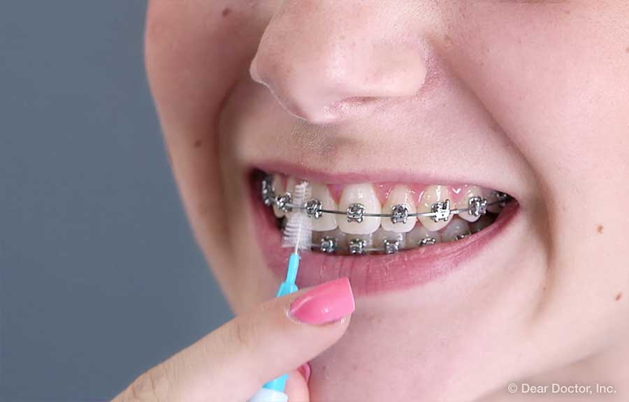 Brushing & Flossing with Braces Sun Orthodontics San Diego California