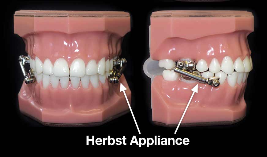 Types of Appliances West Brook Orthodontic Center Ringwood New Jersey