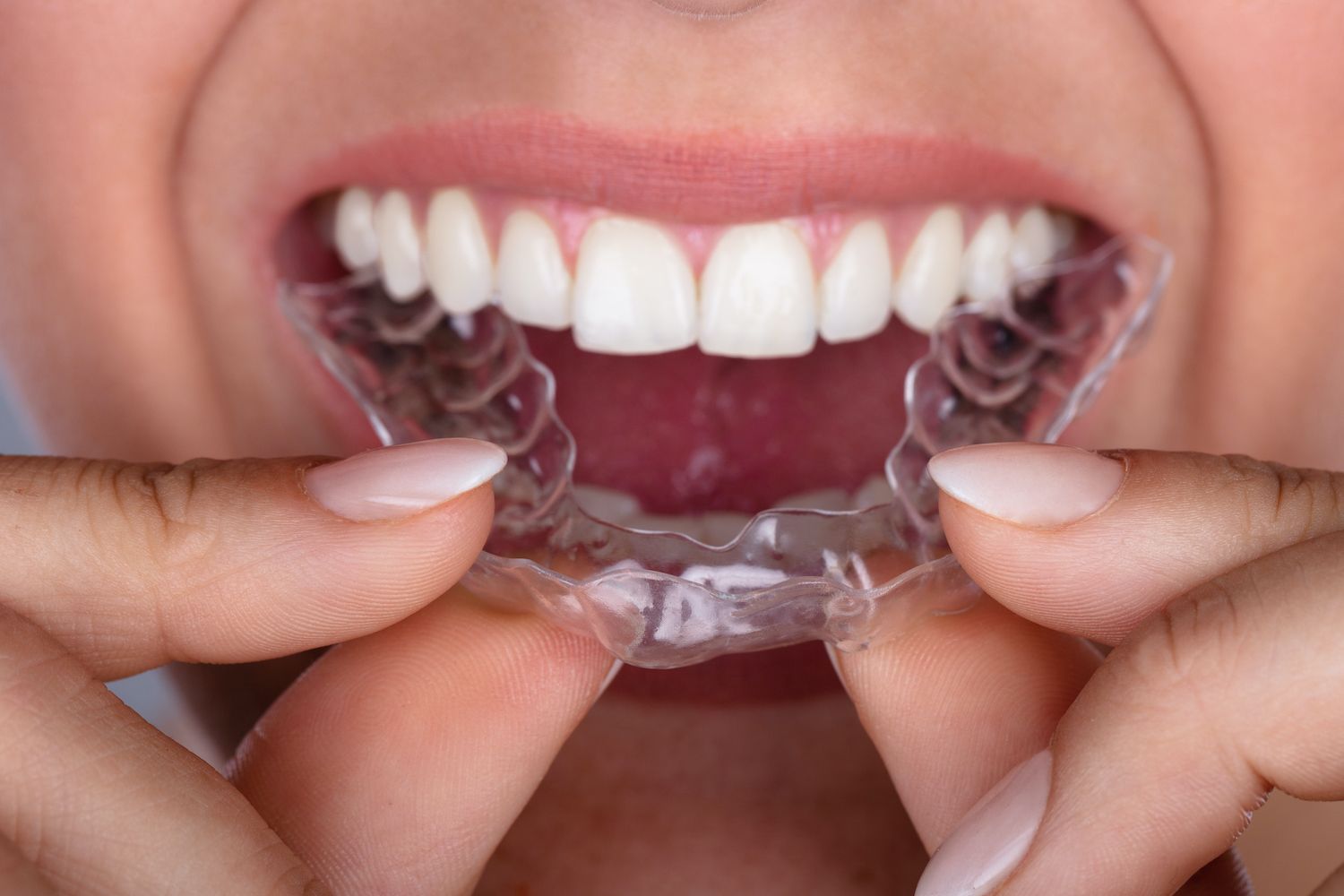 How Can I Keep Invisalign Clean? Irving, TX Orthodontist