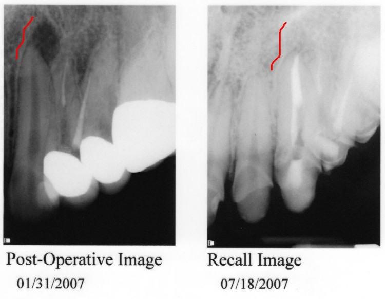 Tooth 11 Amy's Gripping Commentary
