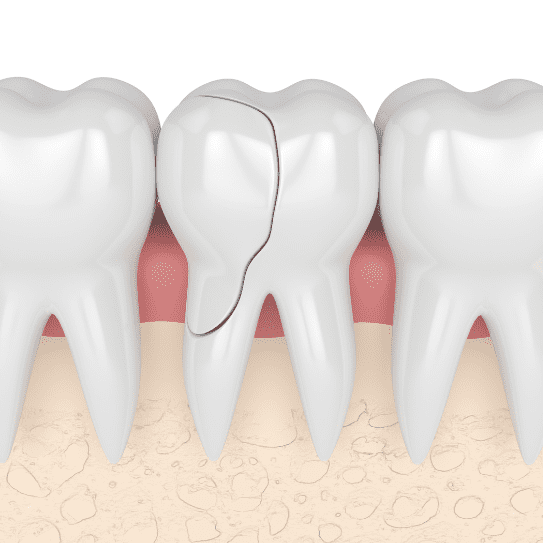 Endodontist in Las Vegas 5 Signs of a Cracked Tooth