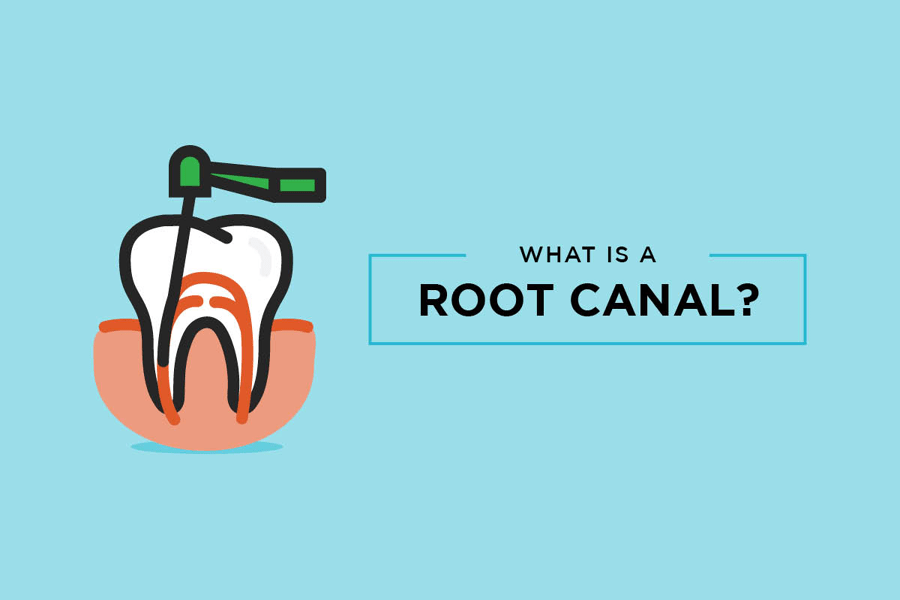 Root canal treatment What is a root canal and why is it done?