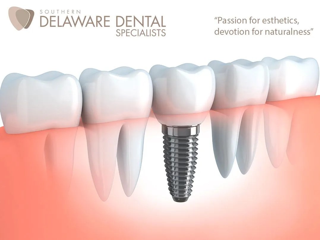 Dental Implants in Southern Delaware Dental Specialists
