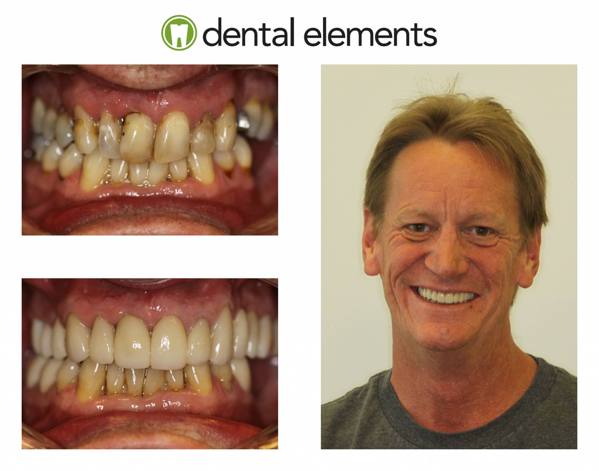 Gallery Dental Elements