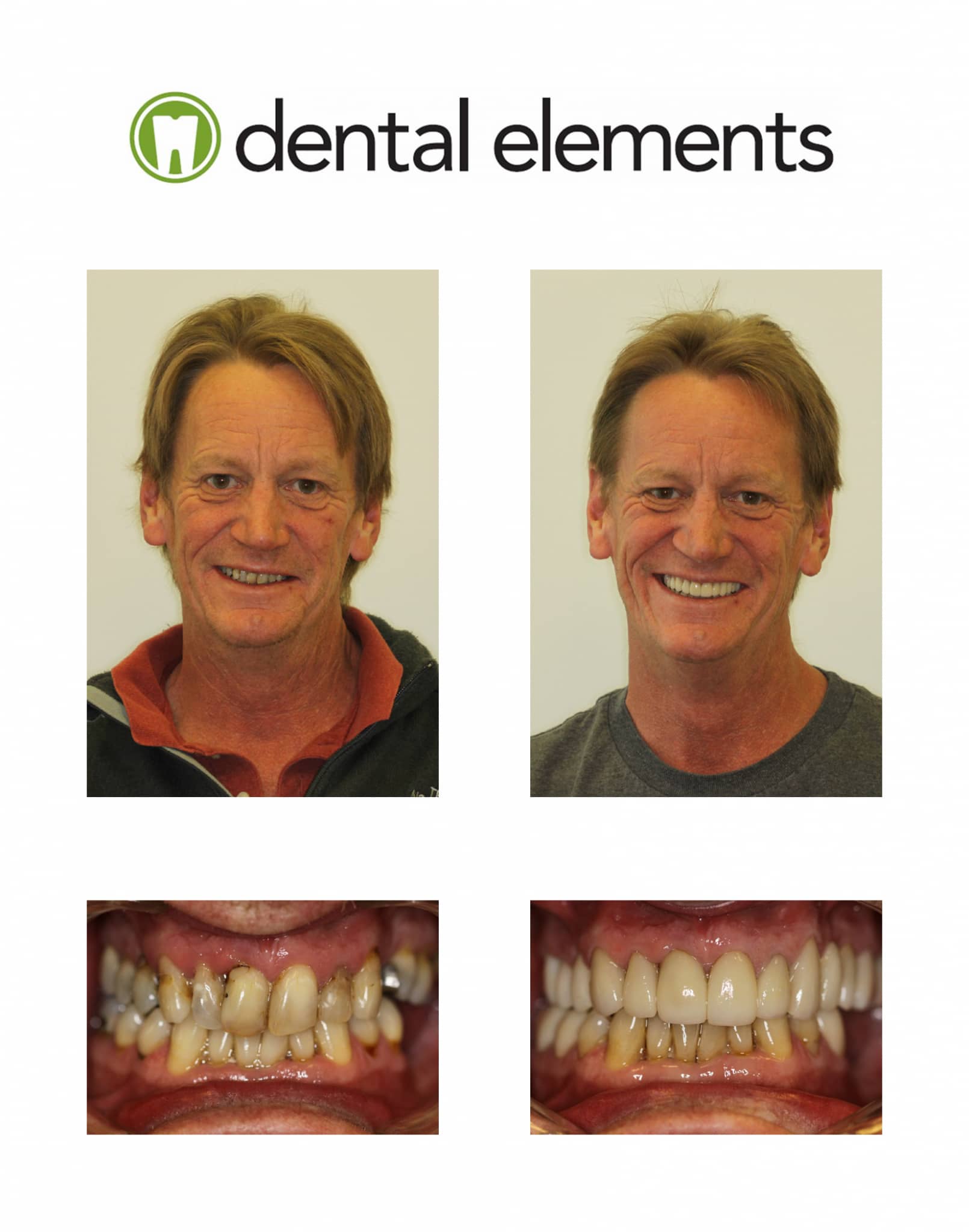 Gallery Dental Elements