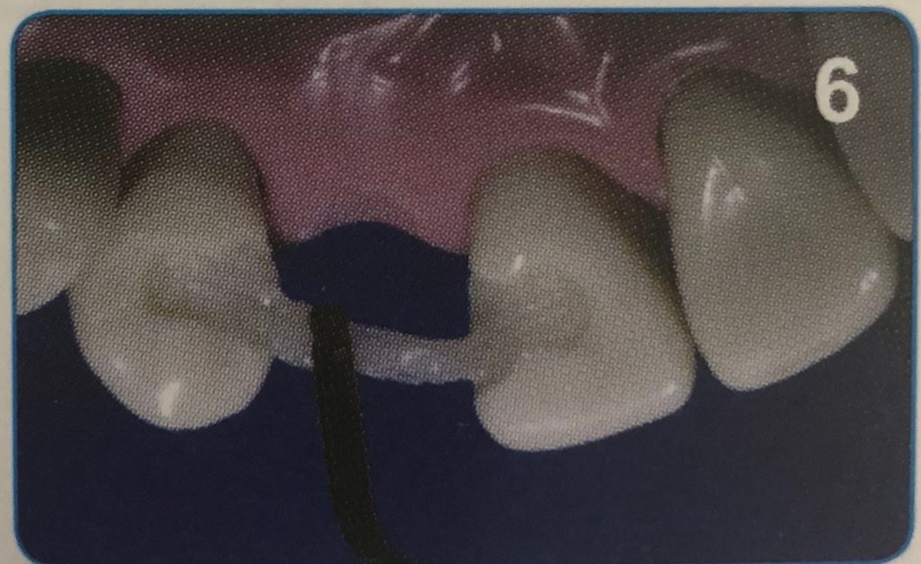 The Direct Bridge Ribbond Bondable Reinforcement Ribbon Dental Head