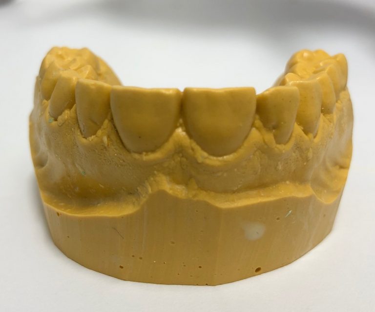 Whitening trays Construction guide Dental Head Start