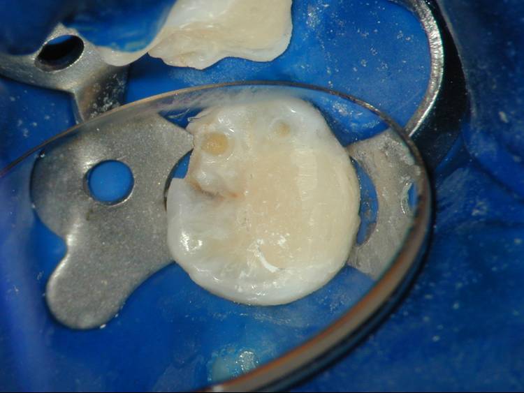 Endodontics Pulp Capping Enhanced Dental CPD Online