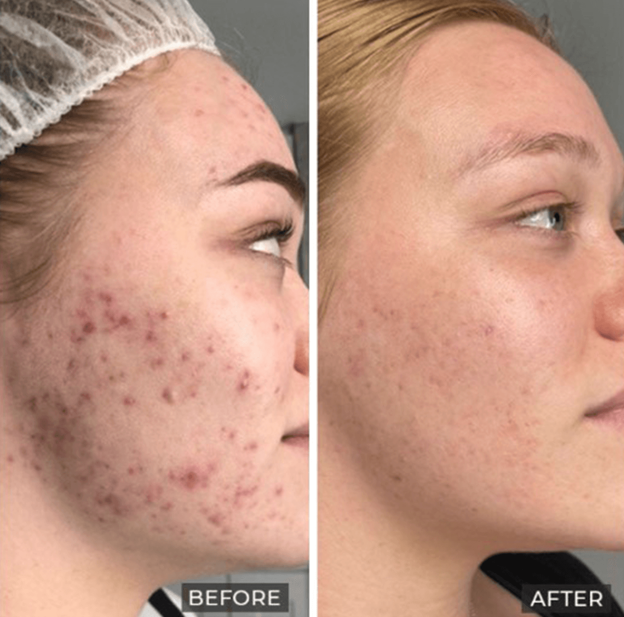 LED Phototherapy Dermalux in Billericay PhototherapyEssex