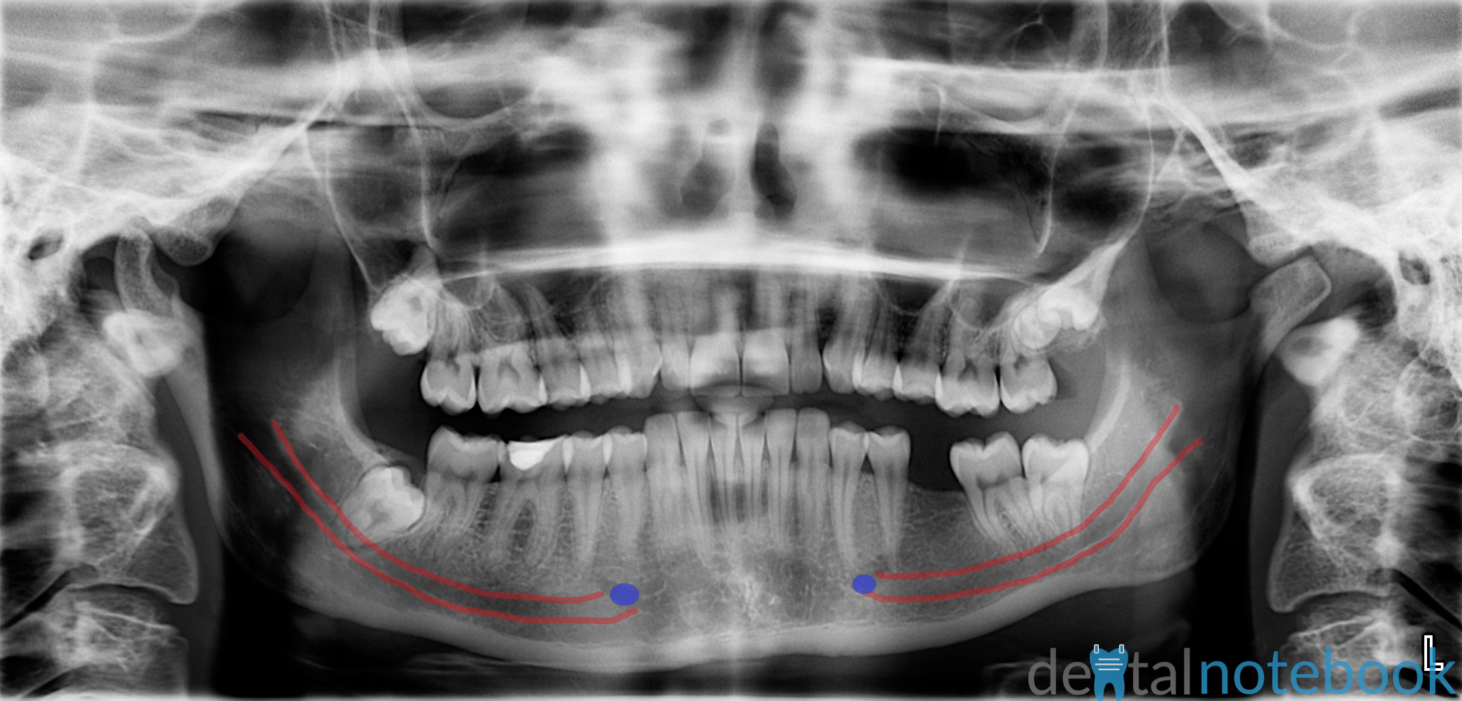 Anatomy of Panoramic Films OPTs/DPTs/OPGs dentalnotebook