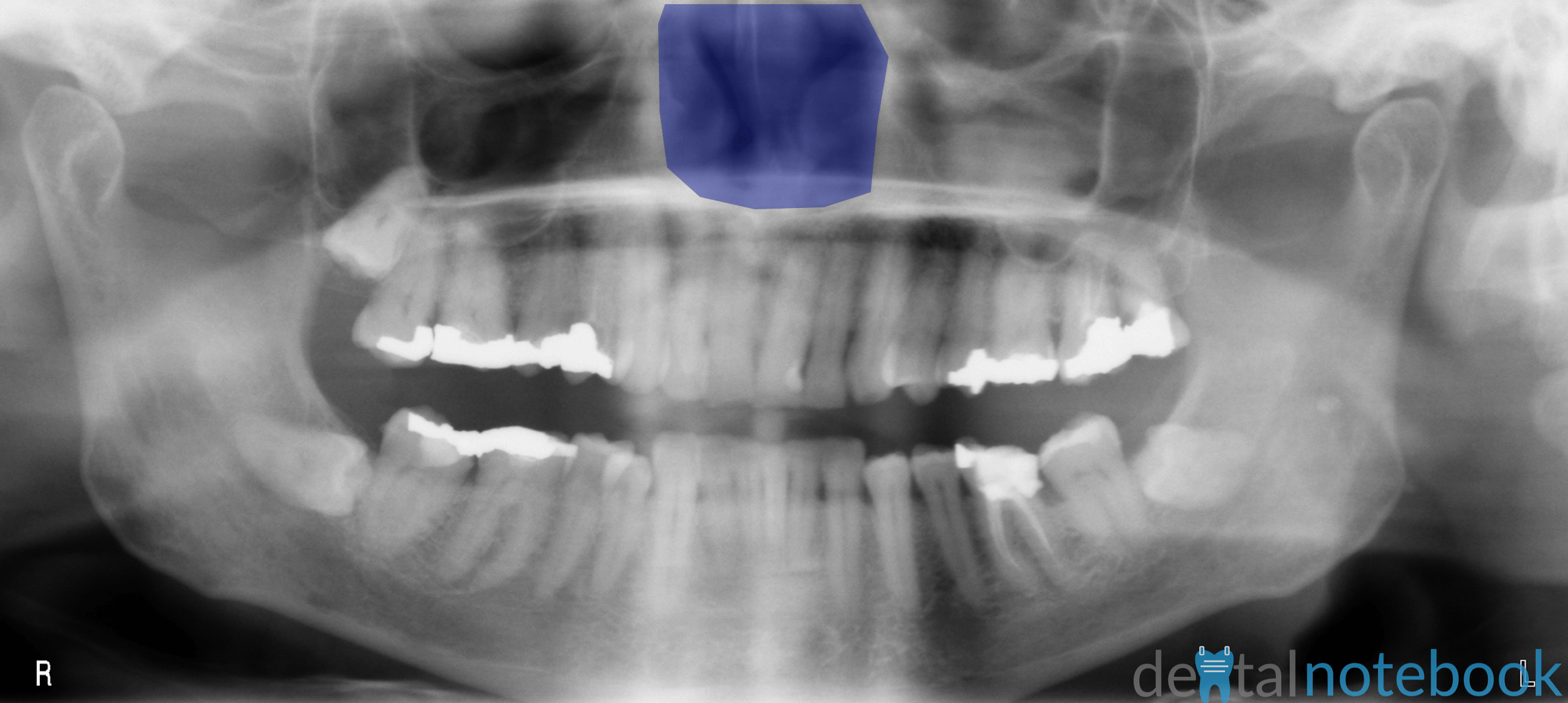 Anatomy of Panoramic Films OPTs/DPTs/OPGs dentalnotebook