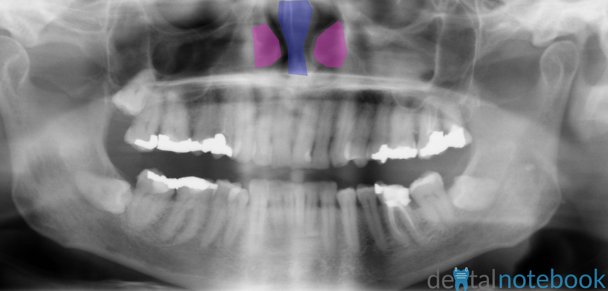 Anatomy of Panoramic Films OPTs/DPTs/OPGs dentalnotebook