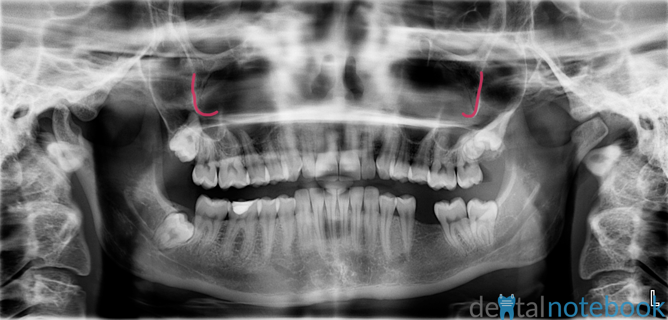 Anatomy of Panoramic Films OPTs/DPTs/OPGs dentalnotebook