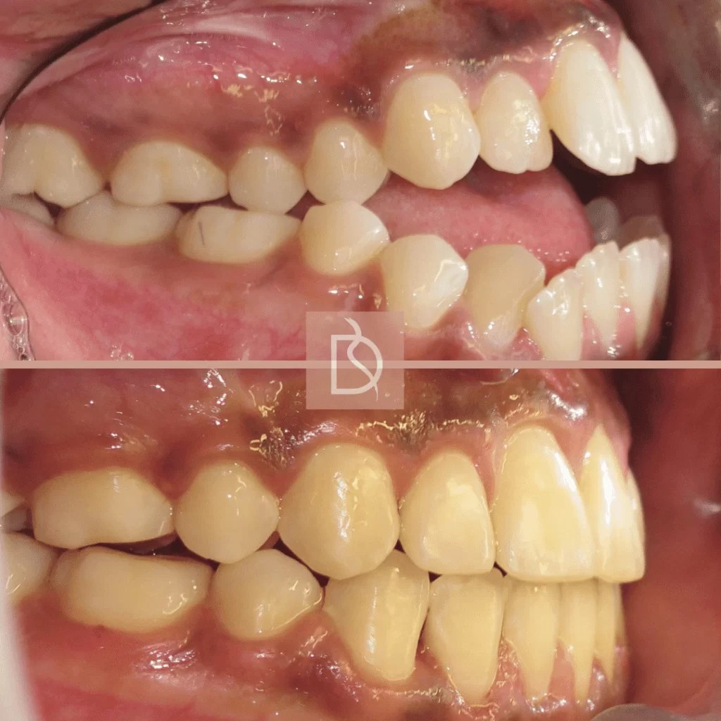 Correcting Bite Function and Jaw Misalignment with Invisalign DOTB