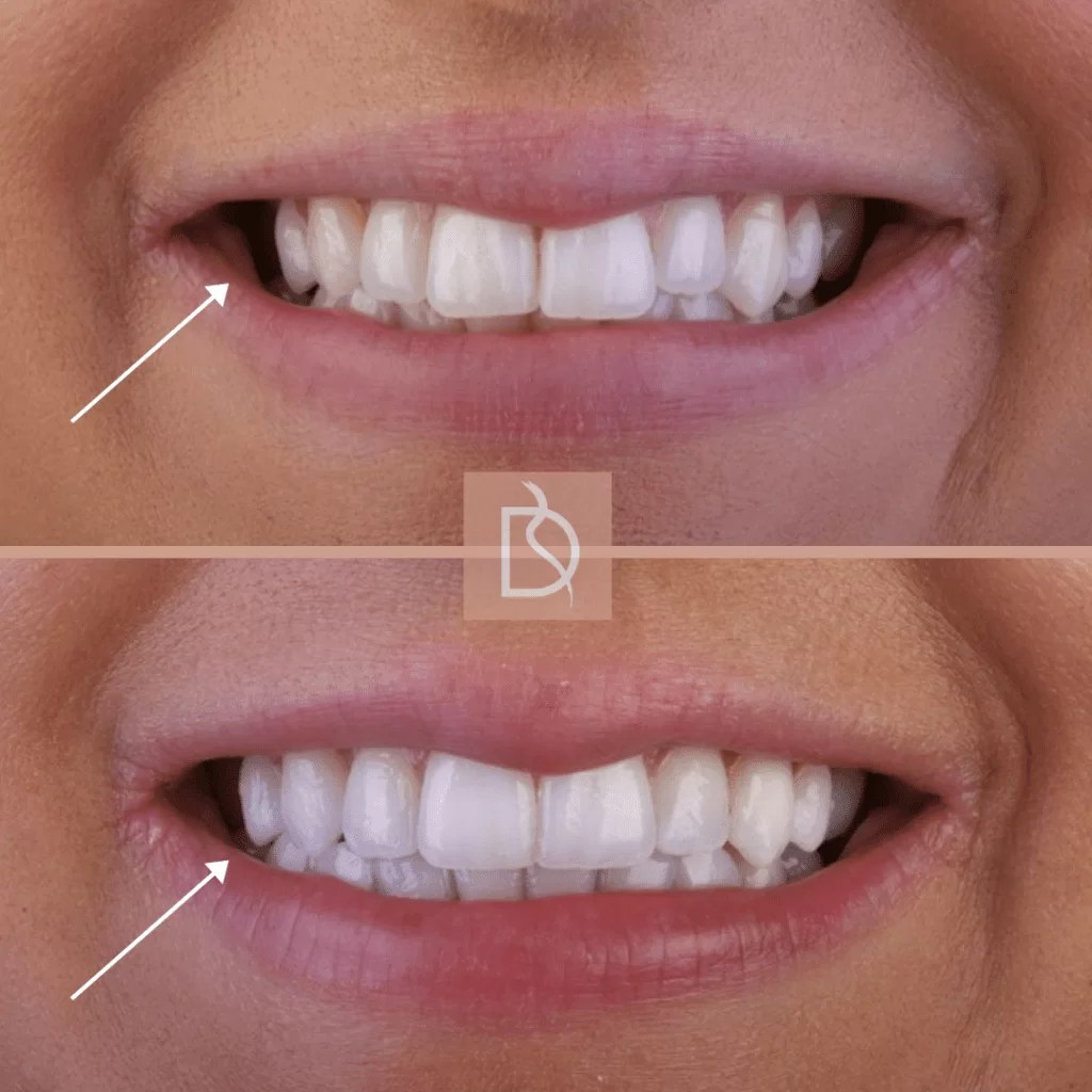 Correcting Bite Function and Jaw Misalignment with Invisalign DOTB