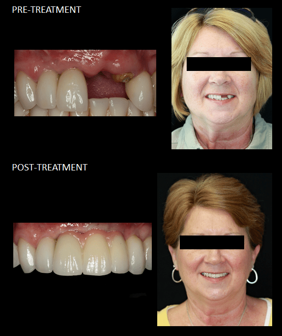 Cosmetic Dental Work Chicago Before & After Photos Cosmetic Dentistry