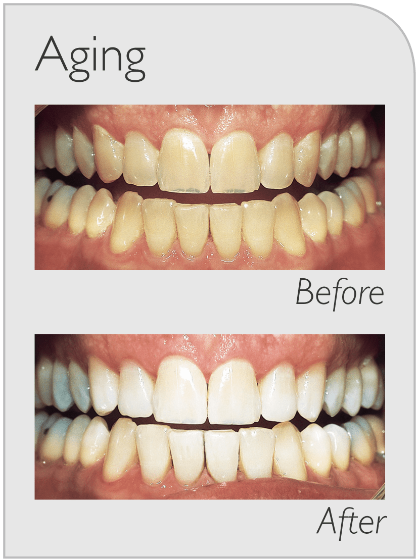 Teeth Whitening Sydney Ryde ZOOM Whitening Gladesville North