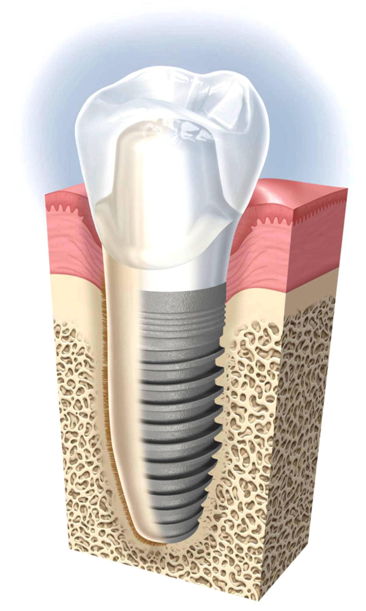 Dental Implants Sydney Dentist Ryde Tooth Replacement Gladesville