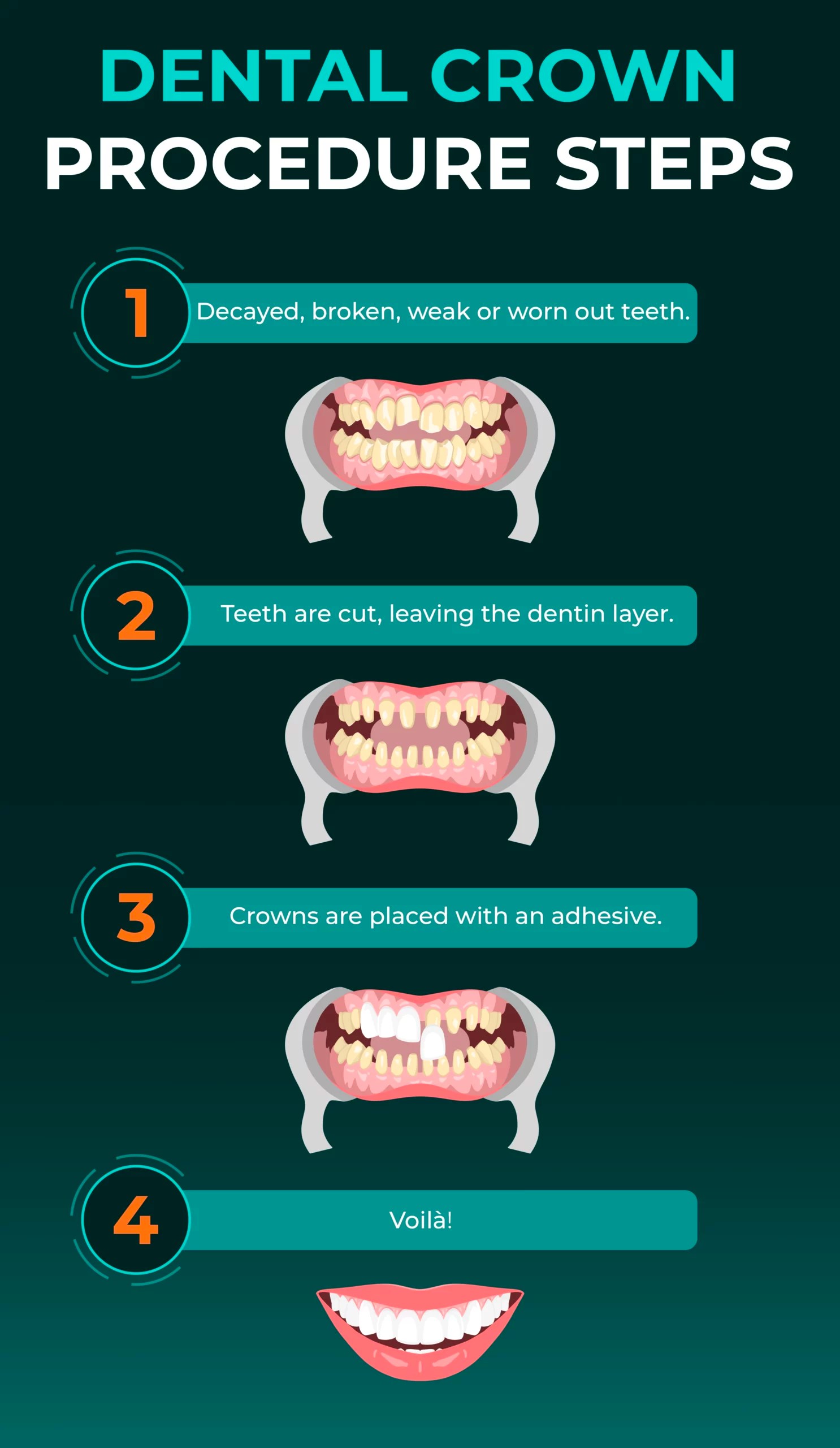 Dental Crown Procedure Prep, Sessions, and Final Result Dentfix