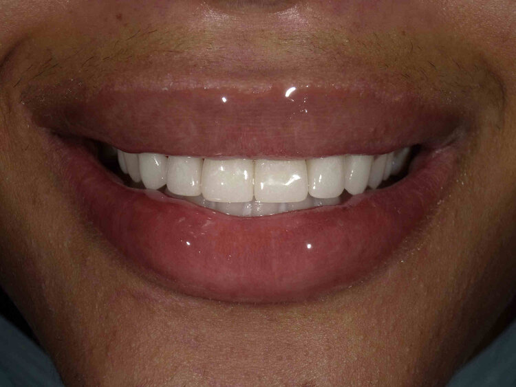 Dentist Before Afters, Smile GallerySpring, Dentist 77379