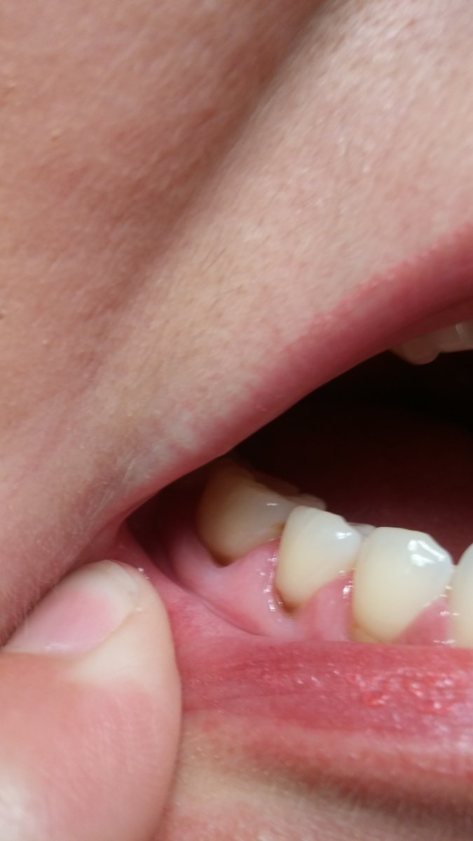Cavity at Gum line? Help Dentistry Forums