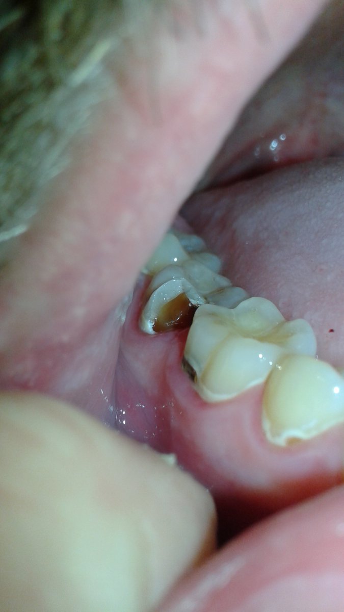 I have a question about a broken tooth. Dentistry Forums