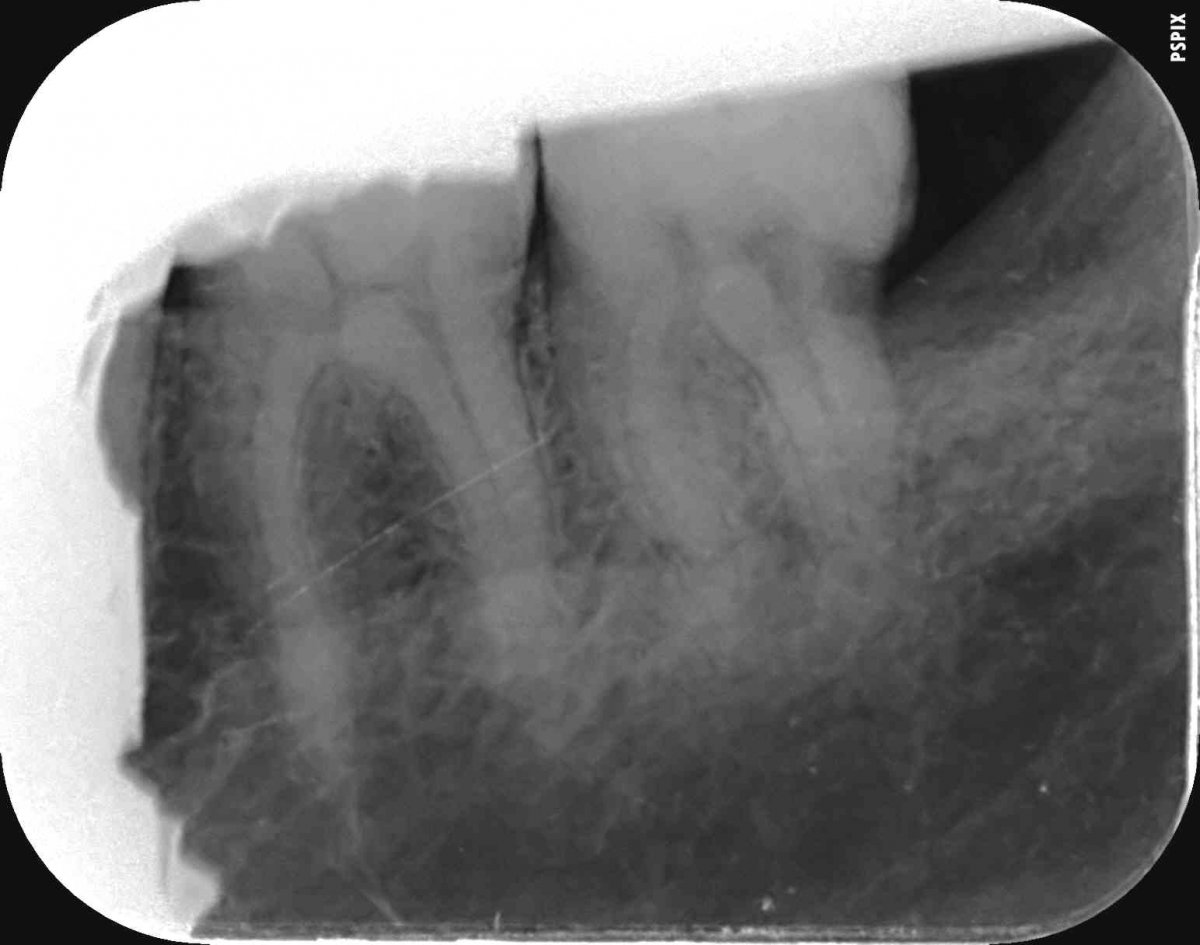 Decay near the root of the tooth Dentistry Forums