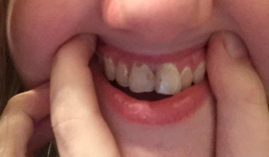 Decay on the gumline by front teeth. Dentistry Forums