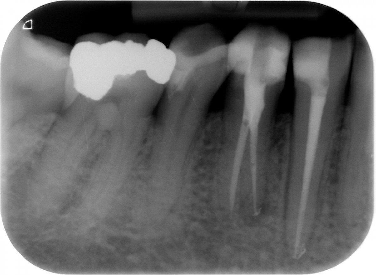 Bioactive cements in endodontics is the use as a root canal sealer