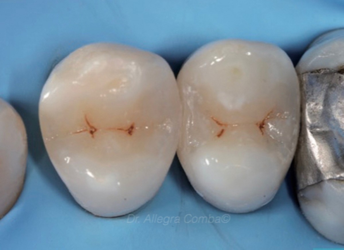 Direct restoration of 1.4 and 1.5 a clinical case Dentistry33