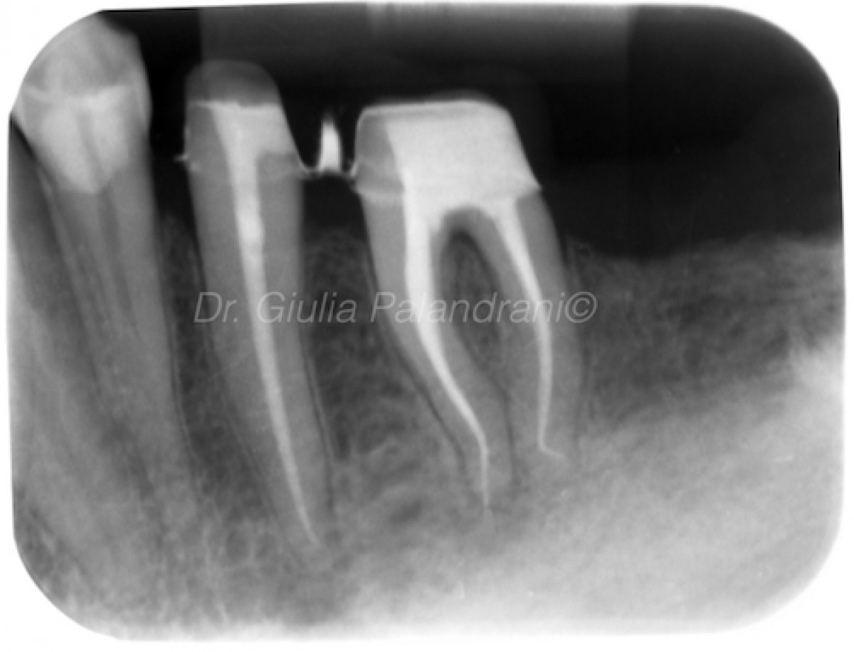 Prevalence of apical Periodontitis in endodontically treated teeth