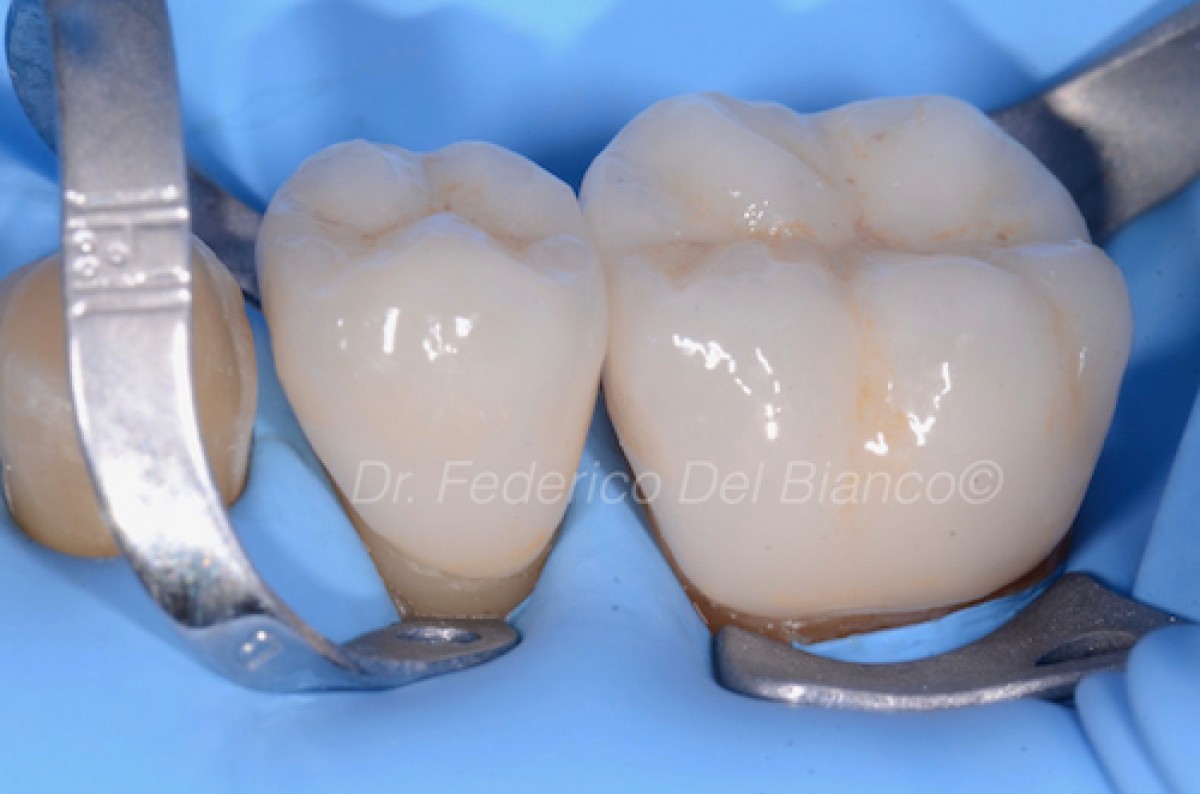How to lute chairside CADCAM ceramics Dentistry33