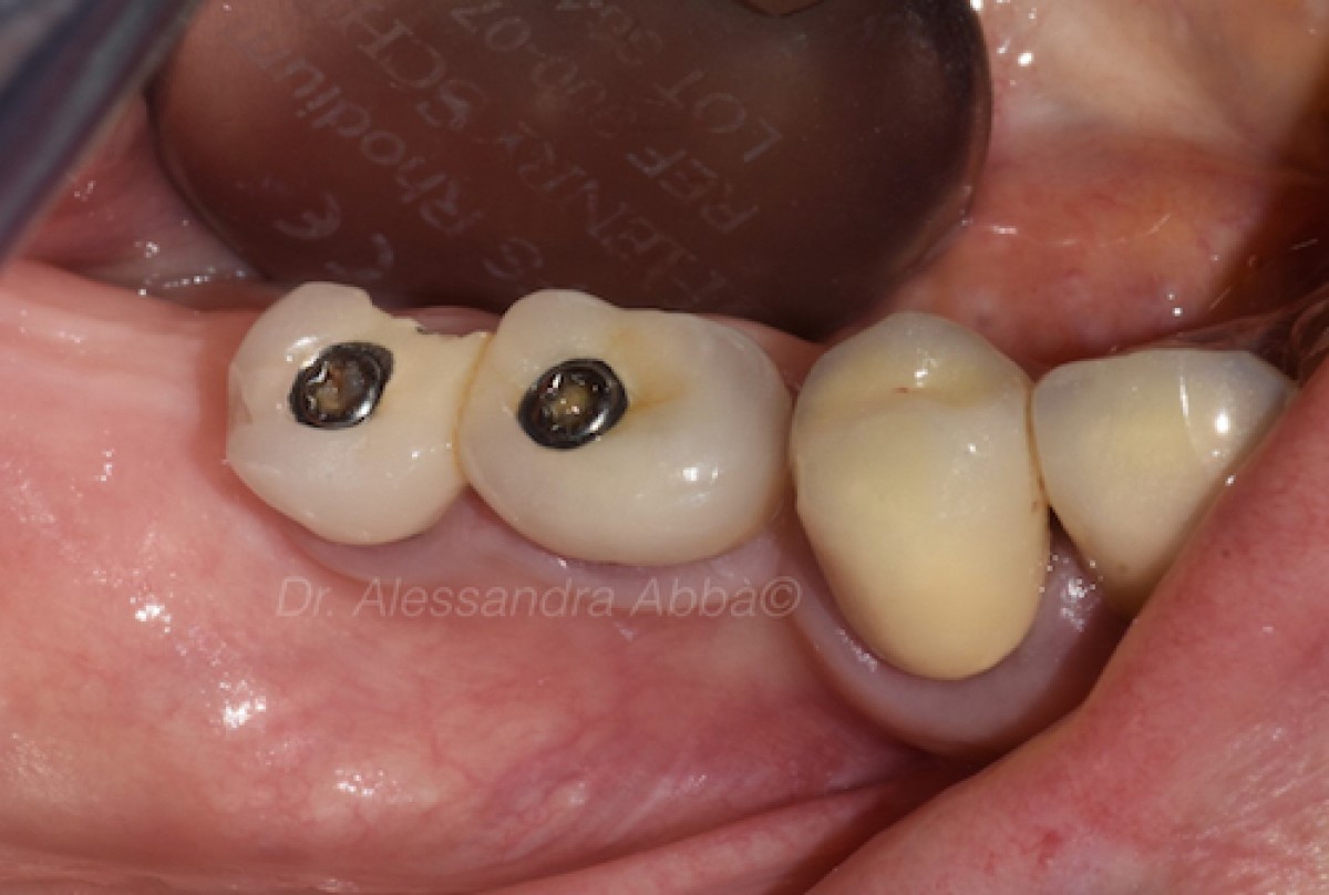 Fixed dental prostheses which is the gold standard material? Dentistry33