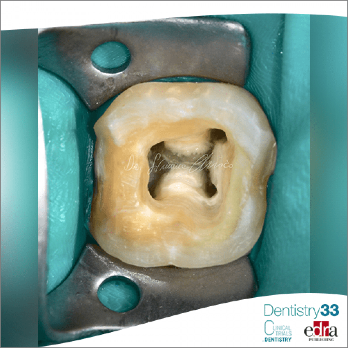 Minimally invasive access cavity and reduced root canal shaping how do