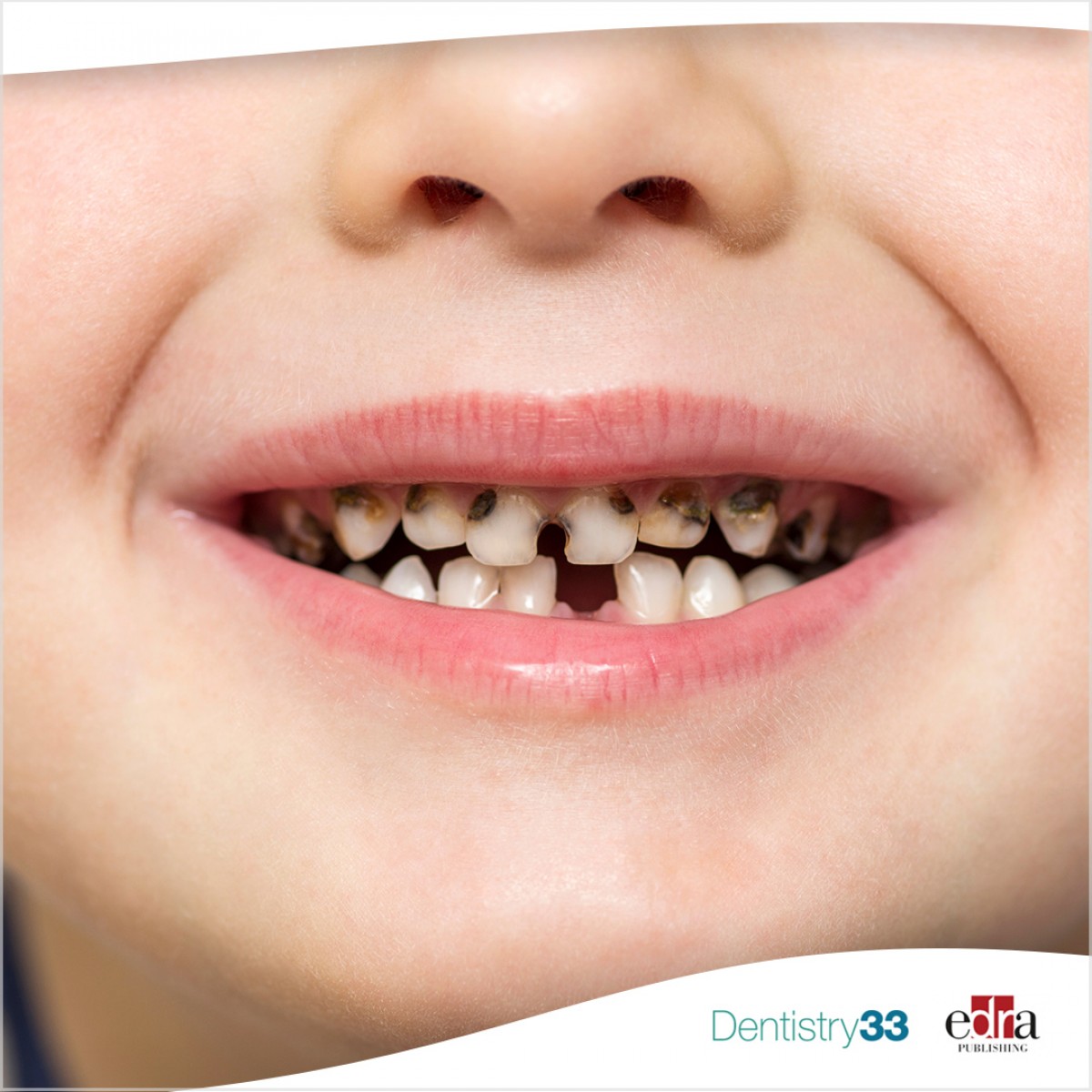 Resinmodified glass ionomer cement had better restoration, color and