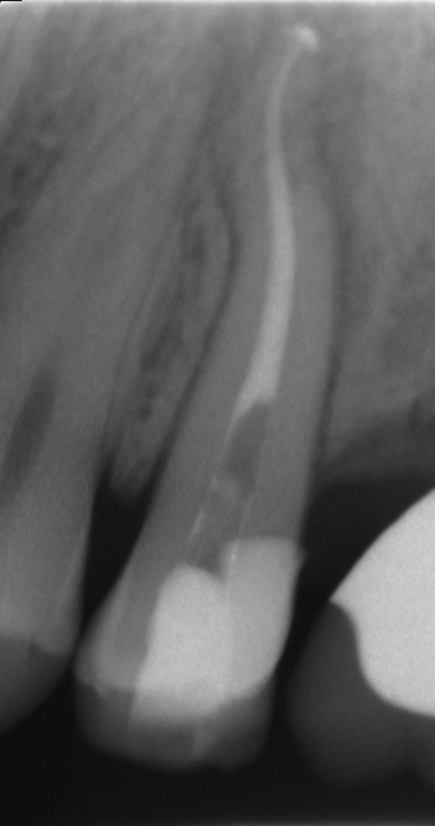 Heat treated Niti Alloys and modern Endodontics Dentistry33