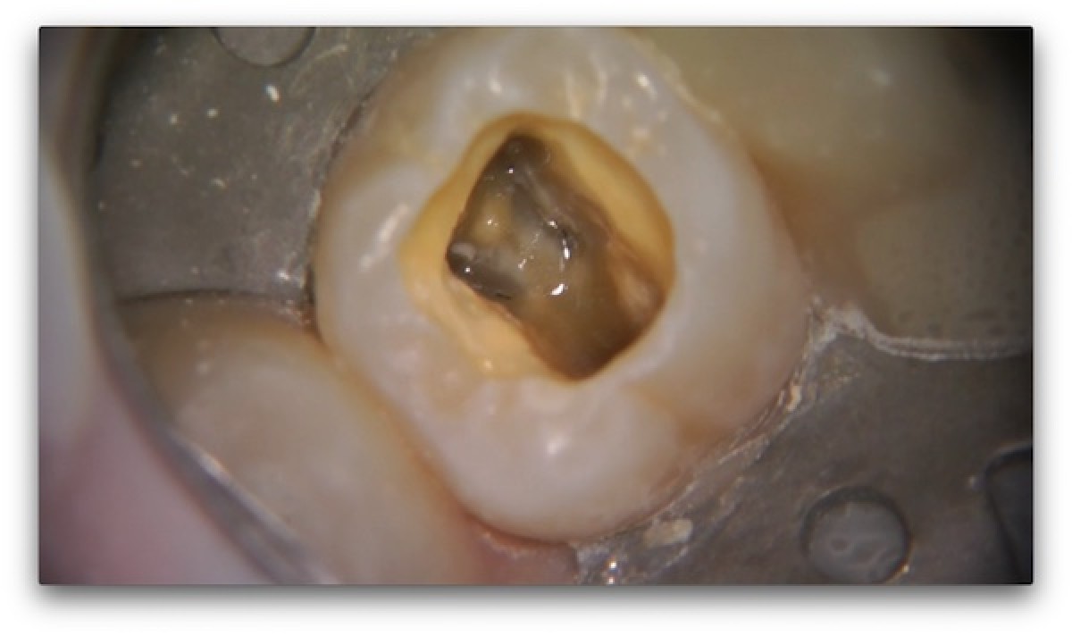 Restoration of endodontically treated molar a clinical case Dentistry33