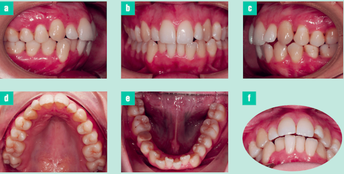 Orthodontic treatment to correct the gummy smile and biprotrusion a
