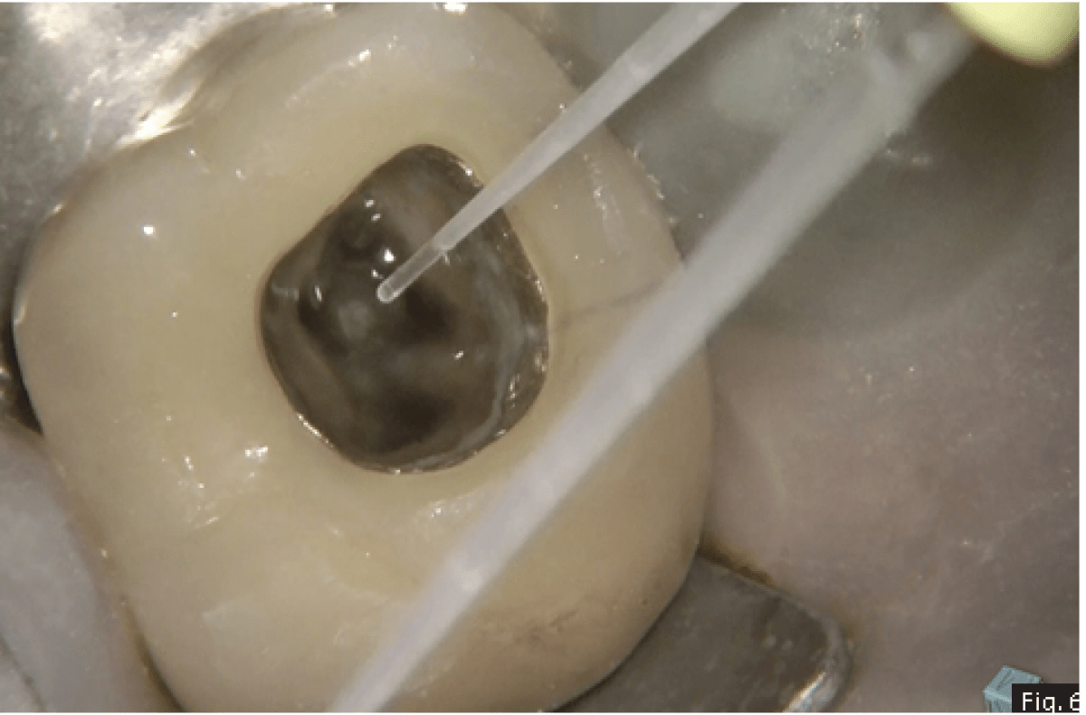 The importance of irrigation in challenging cases Dentistry33