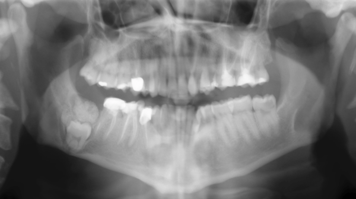 A large radiopaque lesion in the posterior mandible Dentistry33