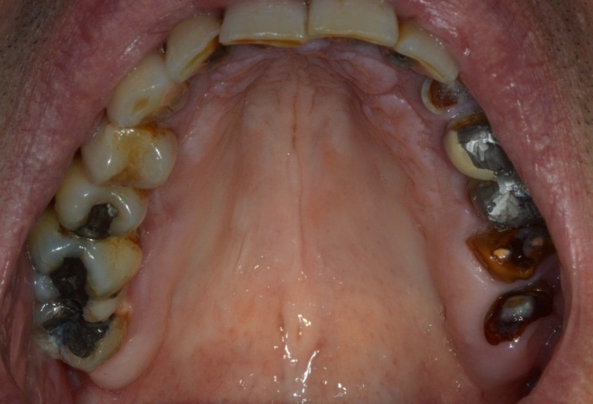 Palatal swelling a clinical case Dentistry33
