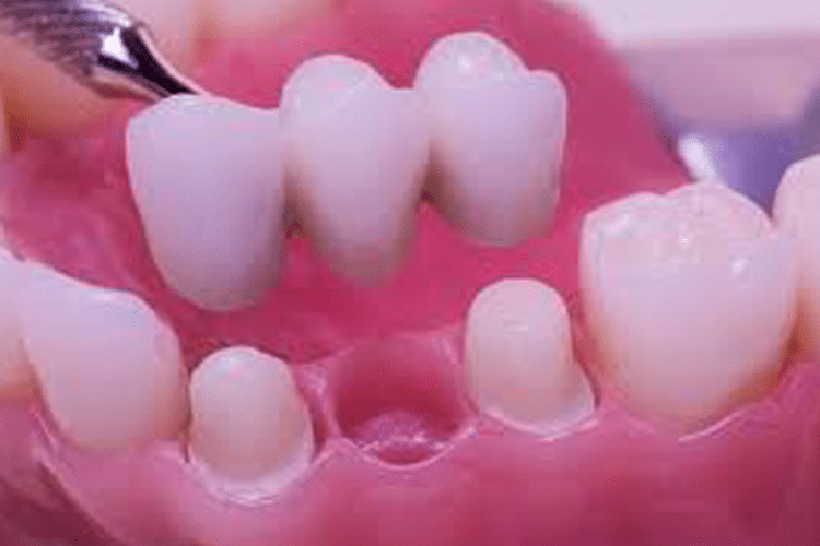 Dental Bridges Risks Dentist In Madison, WI