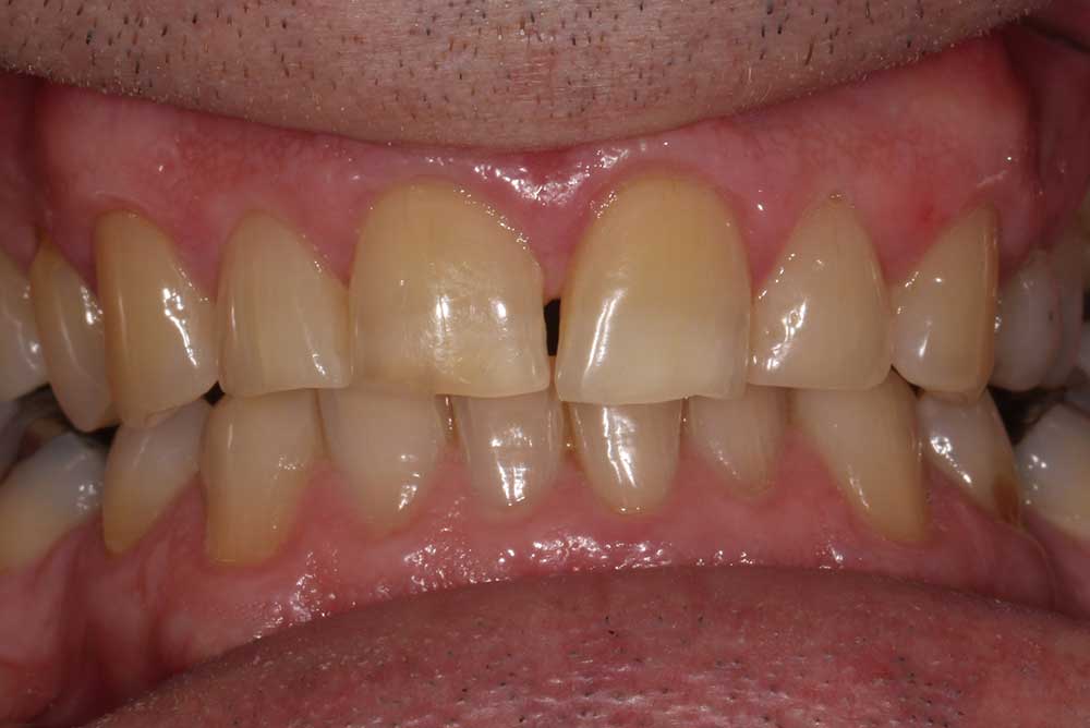 White toothcoloured fillings Dentistry Markethill