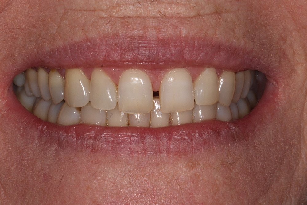 White toothcoloured fillings Dentistry Markethill