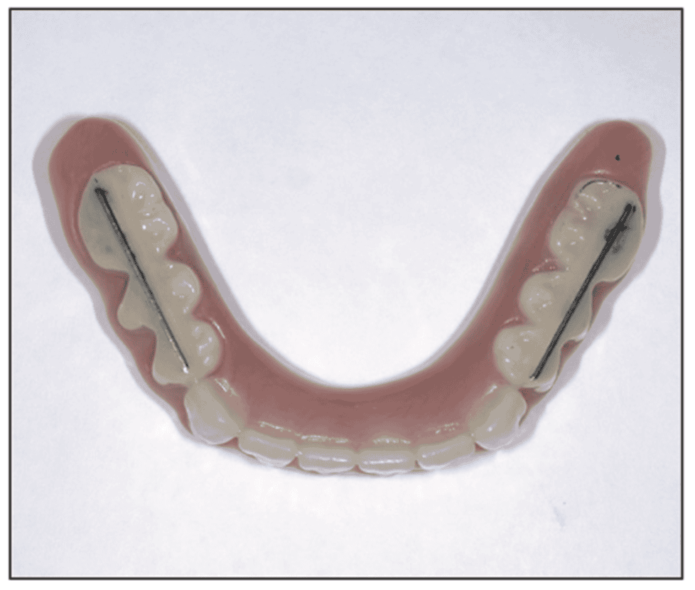 Subperiosteal Implant Still a Viable Treatment for Atrophic Mandibles