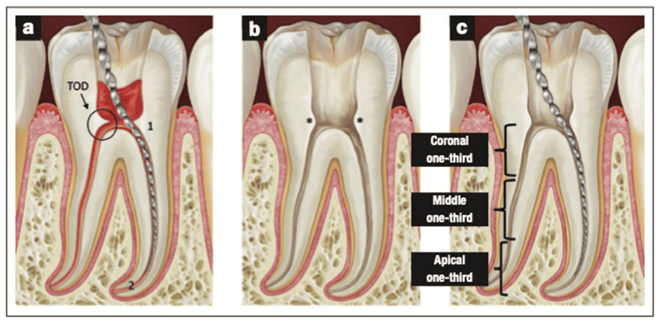 Instrumentation Errors Tips and Tricks to Avoid It Dentistry Today