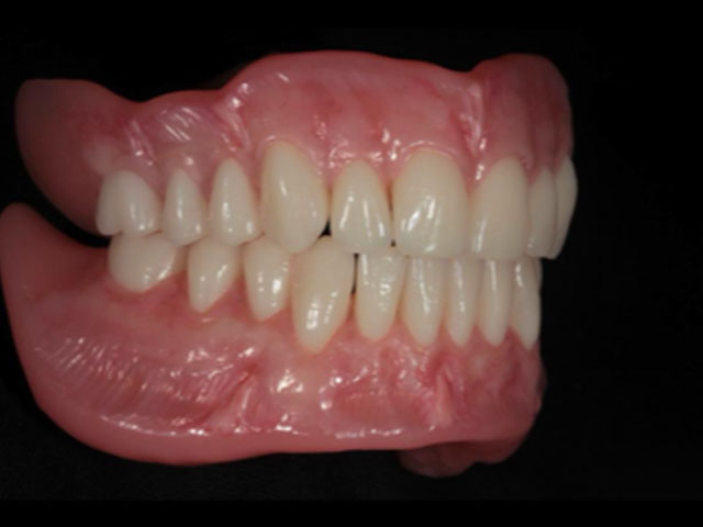 denturepreparation4 Kevin Manners Denture Clinics