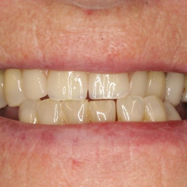 How Long Does it Take to Have a Set of Dentures Made