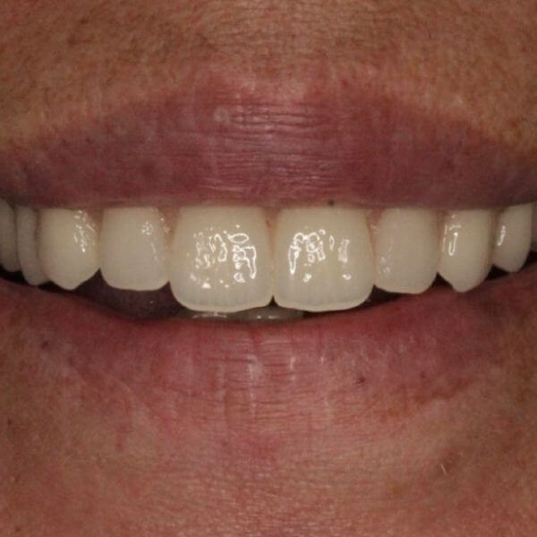 Getting Dental Impressions? Here's What to Expect Colgate