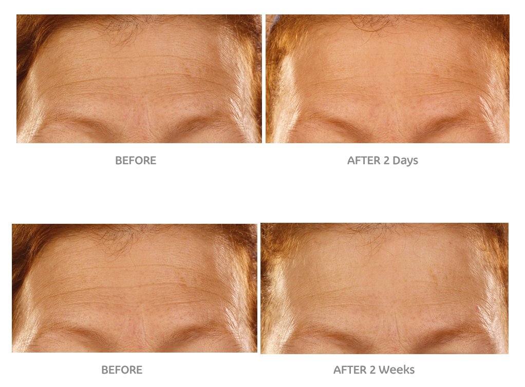WrinkleMD Hyaluronic Acid Infusion System Before & after images Dermacare